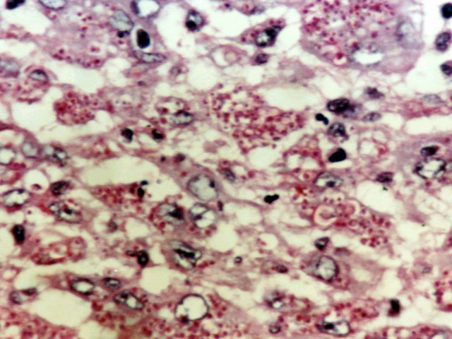 Fig.5: ATLL, Biopsia ganglionar. PAS - <div style=